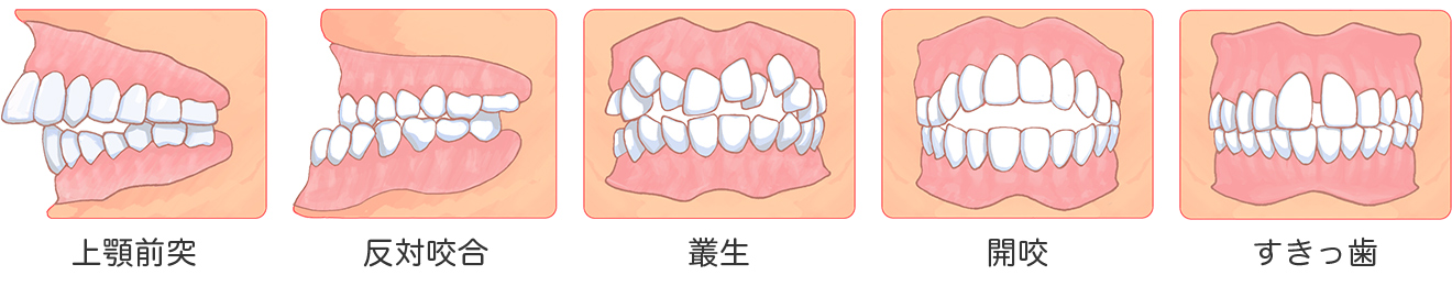 図：不正咬合の種類