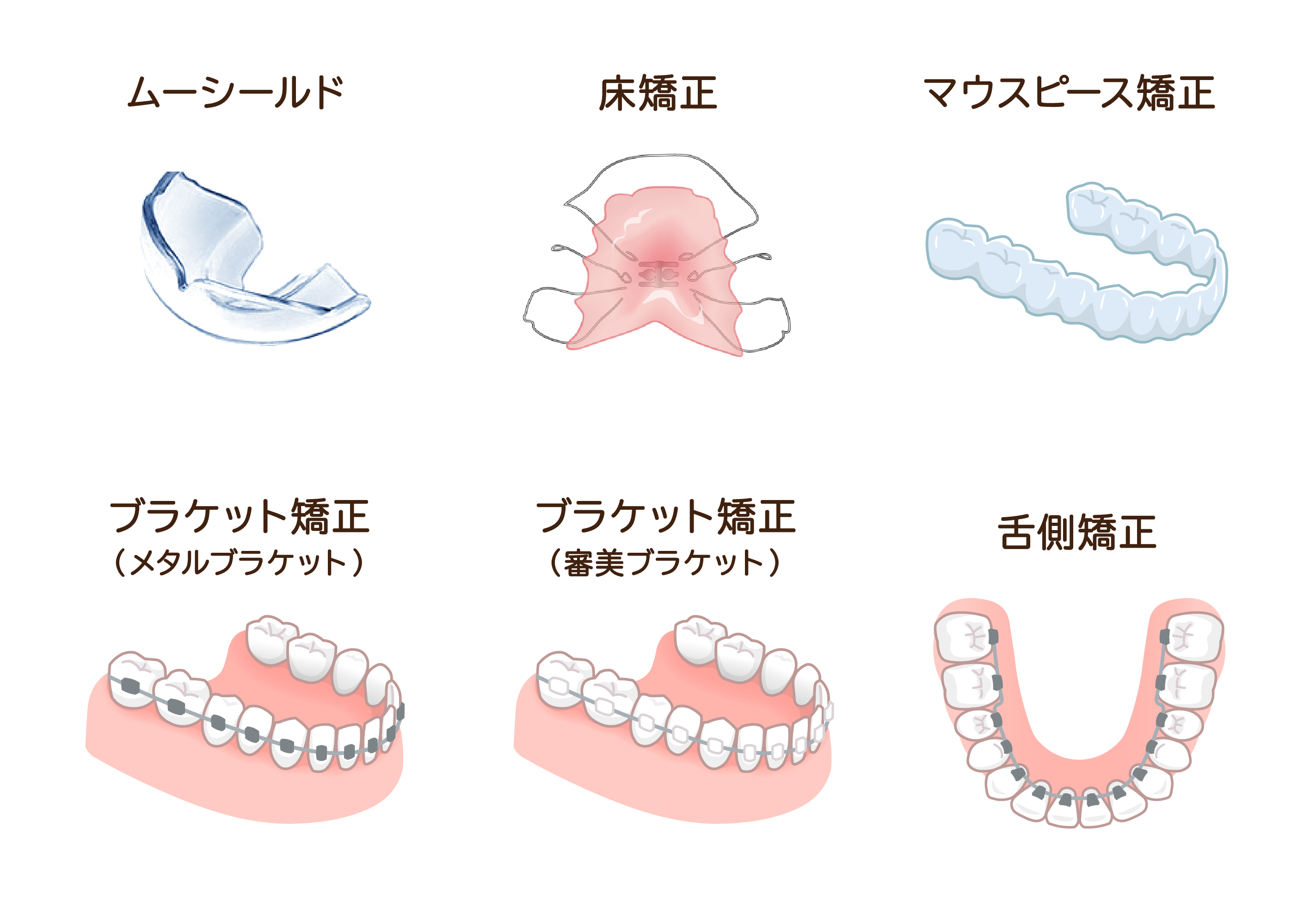 図：矯正歯科治療の種類
