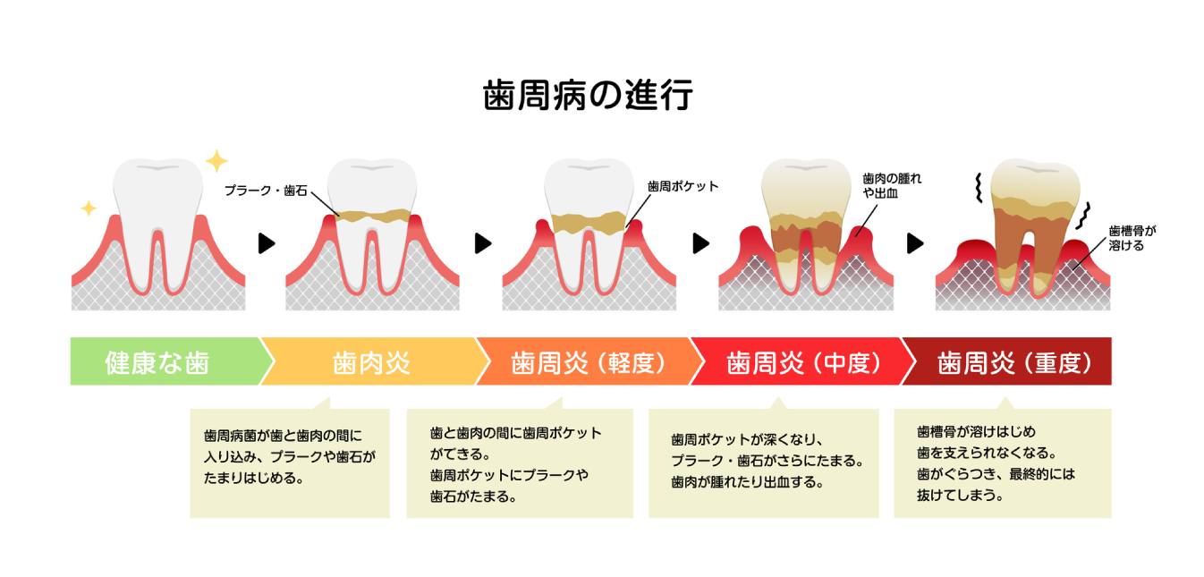 図：歯周病の進行