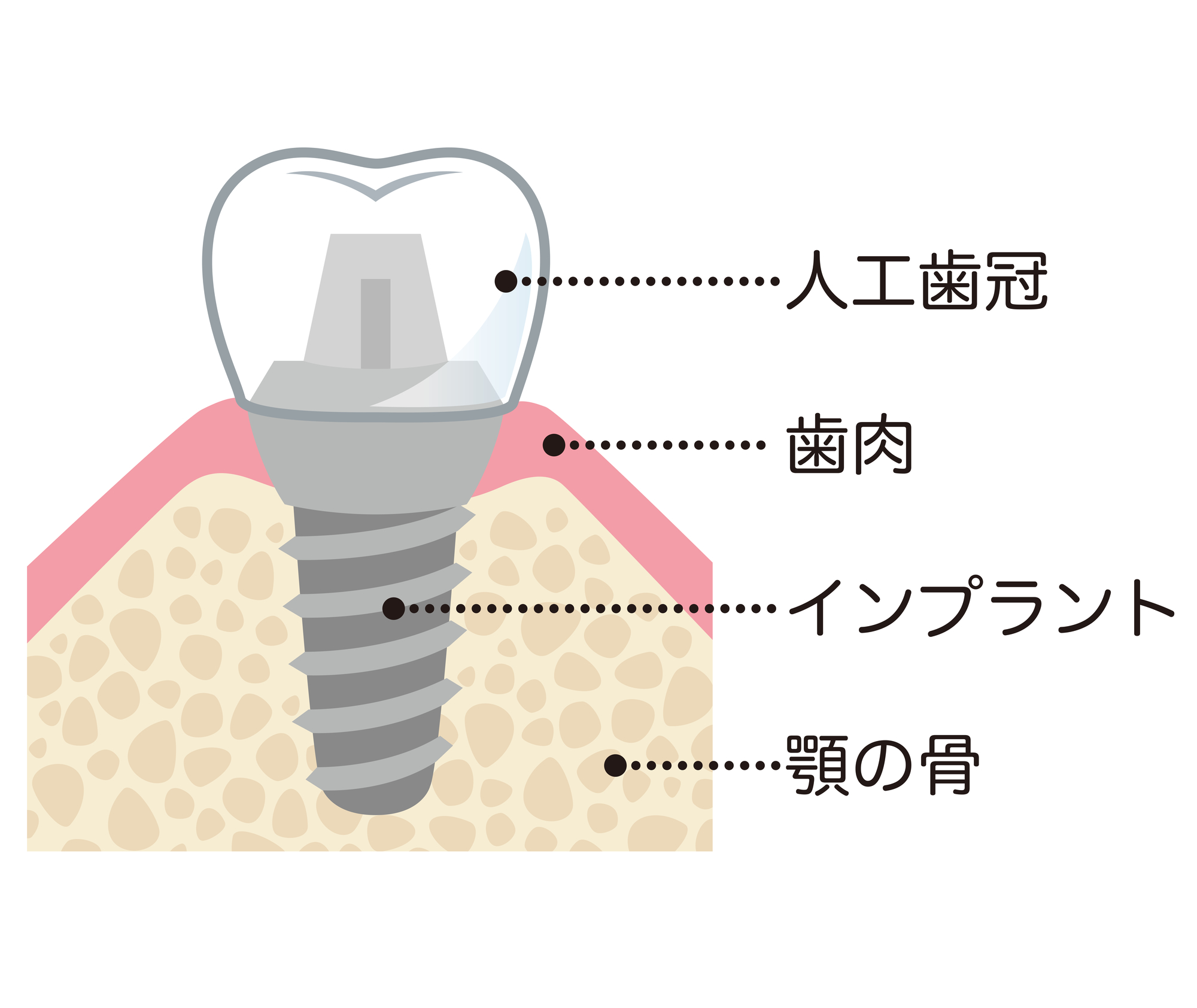 図：インプラントの構造